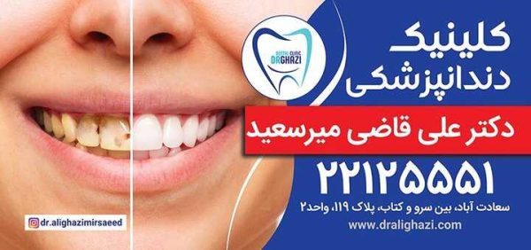 ایمپلنت دندان جایگزینی برای دندان های از دست رفته