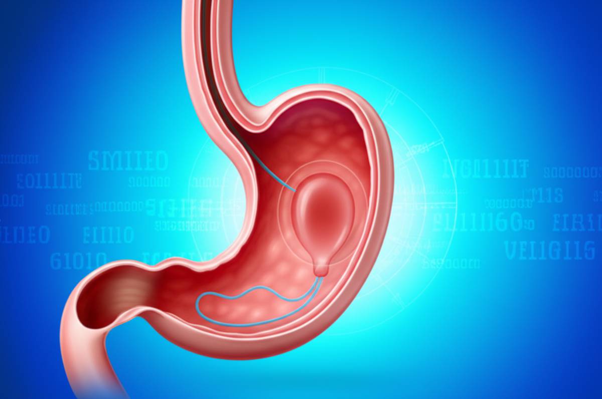 انواع عمل های لاغری معده: راهنمای کامل و جامع